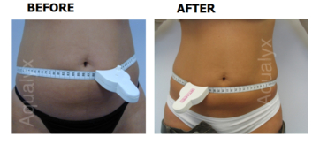 Fantasy: Fat Melting Injections? Or Fiction?